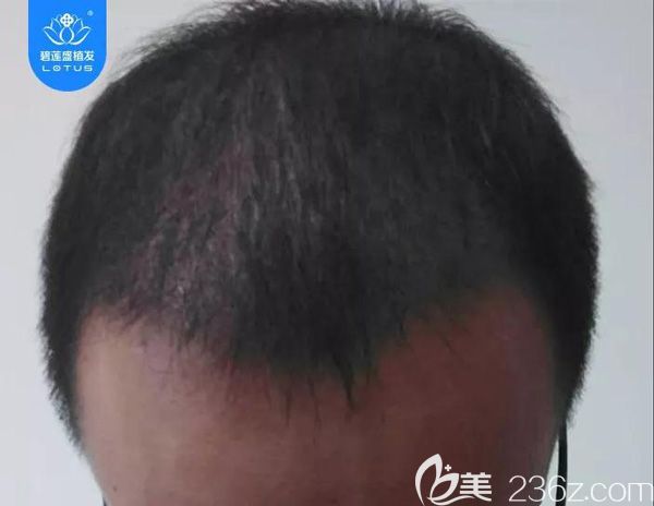 大面積植發(fā)術后3個月脫發(fā)期效果 大面積植發(fā)術后3個月脫發(fā)期效果