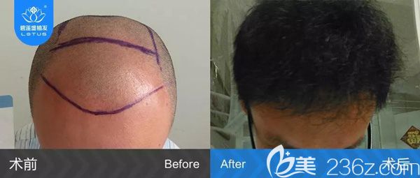 6級脫發(fā)植發(fā)4500單位前后對比效果圖 6級脫發(fā)植發(fā)4500單位前后對比效果圖