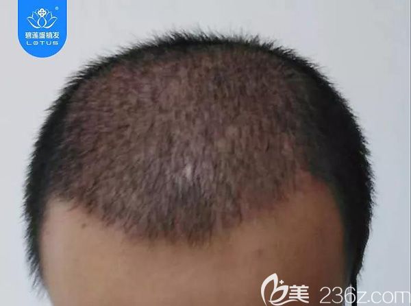 植發(fā)4500單位術后一個月效果圖 植發(fā)4500單位術后一個月效果圖