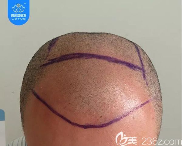 大面積植發(fā)術前設計 大面積植發(fā)術前設計