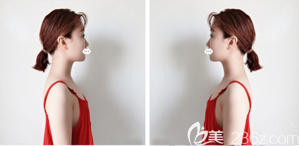 在梅州曙光整形醫(yī)院做隆胸術(shù)前照片 在梅州曙光整形醫(yī)院做隆胸術(shù)前照片