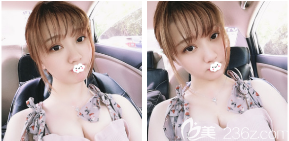 忍不住來(lái)秀一波我剛花2萬(wàn)多元在梅州曙光醫(yī)院做的自體脂肪隆胸效果給大家看看