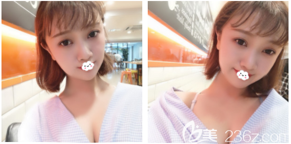 梅州曙光自體脂肪豐胸1個月效果圖 梅州曙光自體脂肪豐胸1個月效果圖