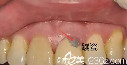 烤瓷牙蹦瓷 烤瓷牙蹦瓷