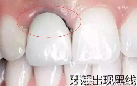 =牙齦黑線 =牙齦黑線