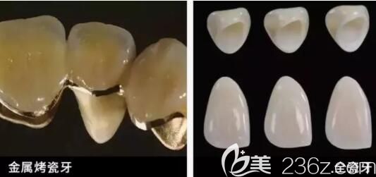 全瓷牙和烤瓷牙圖片 全瓷牙和烤瓷牙圖片