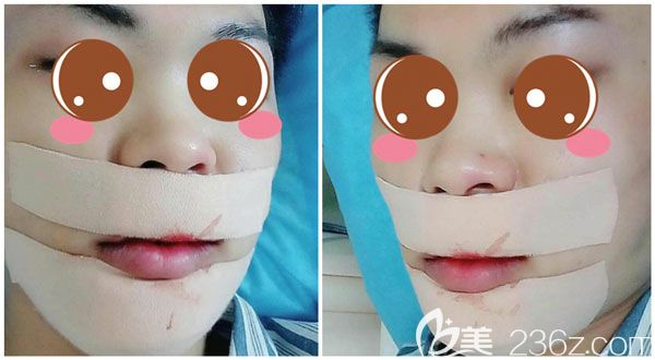 雙鄂手術(shù)第二天下頜緣位置一直貼著膠帶