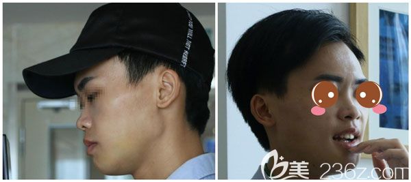 雙鄂手術(shù)恢復(fù)2個(gè)月輪廓線條變得很自然