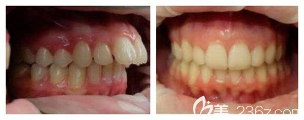 在廣<!--<i data=20240703-sp></i>-->寧愛(ài)思特做牙齒正畸前后對(duì)比圖
