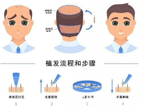 長沙岱高FUE植發(fā)手術(shù)流程 長沙岱高FUE植發(fā)手術(shù)流程