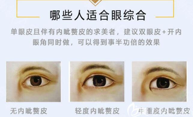 哪些人適合做眼綜合