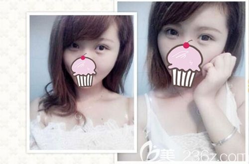 南陽華美王培生醫(yī)生做的雙眼皮效果 南陽華美王培生醫(yī)生做的雙眼皮效果