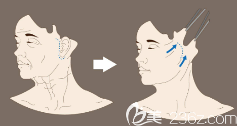 韓國原辰拉皮手術(shù)