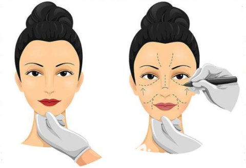 韓國原辰拉皮手術(shù)怎么樣？