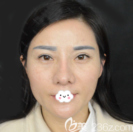 在深圳非凡做雙眼皮修復和隆鼻術(shù)前照片 在深圳非凡做雙眼皮修復和隆鼻術(shù)前照片