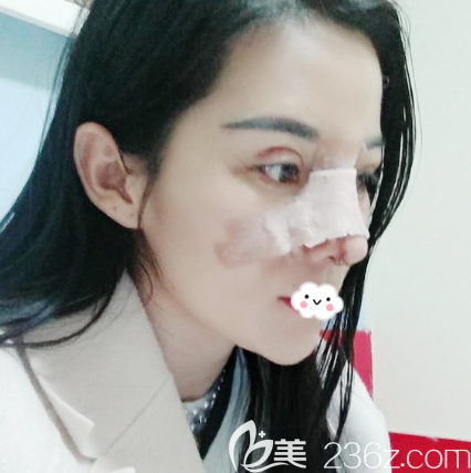 找深圳非凡梅夠明做雙眼皮修復和隆鼻術(shù)后三天 找深圳非凡梅夠明做雙眼皮修復和隆鼻術(shù)后三天