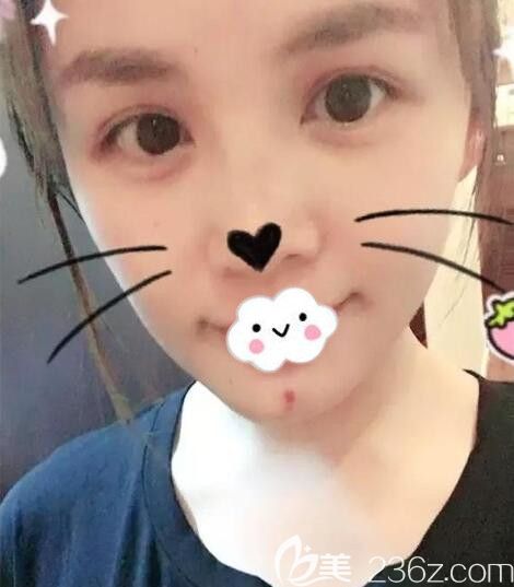 孝感天妃硅膠假體墊下巴術(shù)后8天恢復(fù)圖