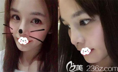 孝感天妃假體墊下巴術(shù)后15天恢復(fù)照片