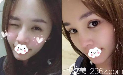 在孝感天妃做合資艷冠假體墊下巴術(shù)后2個月自述,感覺性價比蠻高的