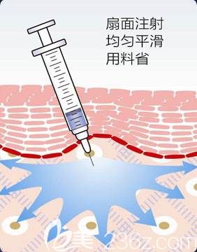 楊主任微整形推崇扇形注射法