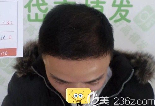 長(zhǎng)沙岱高植發(fā)7個(gè)月后頭發(fā)成功長(zhǎng)出