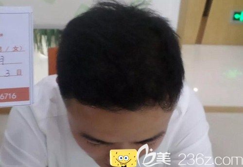 宋先生脫發(fā)6年從小伙變大叔!長(zhǎng)沙岱高做頭頂加密植發(fā)5小時(shí)后有了不一樣的變化