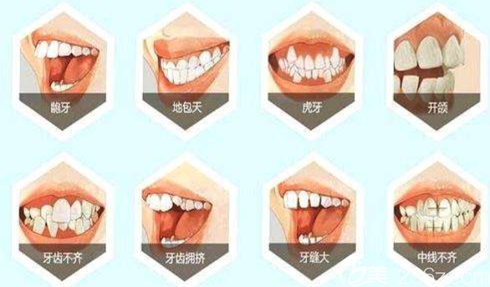 哪些人需要做牙齒矯正