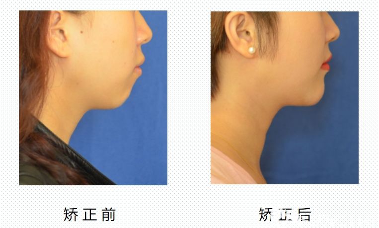 看了長(zhǎng)沙美奧口腔的虎牙矯正臉型變化圖后我pick了隱適美隱形牙套