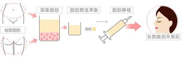自體脂肪填充蘋果肌