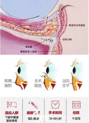 眶隔脂肪釋放原理與手術(shù)時(shí)間 眶隔脂肪釋放原理與手術(shù)時(shí)間
