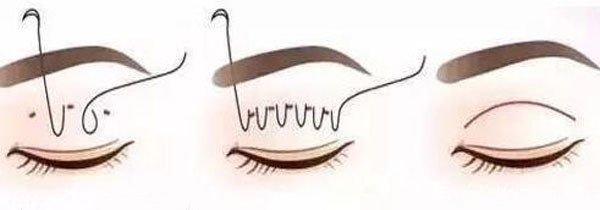 什么是急速納米雙眼皮