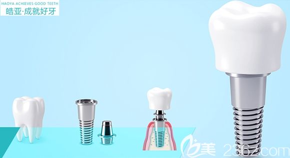 蘭州皓亞齒科種植牙成就好牙