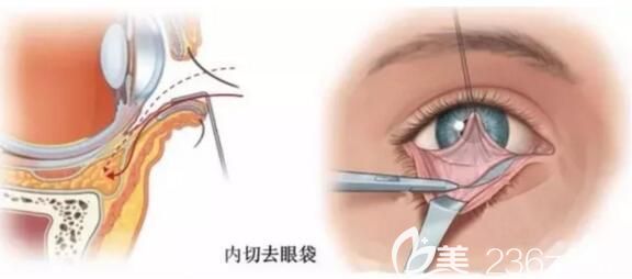 內(nèi)切祛眼袋的位置 內(nèi)切祛眼袋的位置