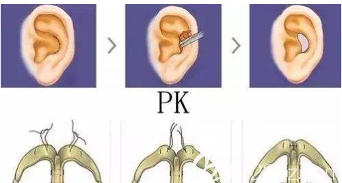 雙側(cè)耳軟骨鏡像移植隆鼻手術(shù)可以幫助你實現(xiàn)擁有水滴鼻的夢想