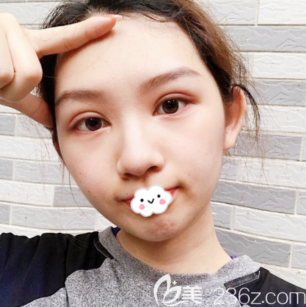 廣州全切雙眼皮術(shù)后15天效果反饋 廣州全切雙眼皮術(shù)后15天效果反饋