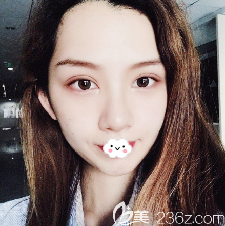 查詢醫(yī)療資質(zhì)發(fā)現(xiàn)廣州荔醫(yī)整形是正規(guī)靠譜的醫(yī)院后花1萬多元做了全切雙眼皮