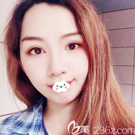 這是花1萬多元在廣州荔醫(yī)整形做的雙眼皮 這是花1萬多元在廣州荔醫(yī)整形做的雙眼皮