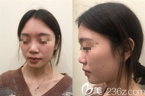 信陽東方藝整形鼻綜合真人案例 信陽東方藝整形鼻綜合真人案例