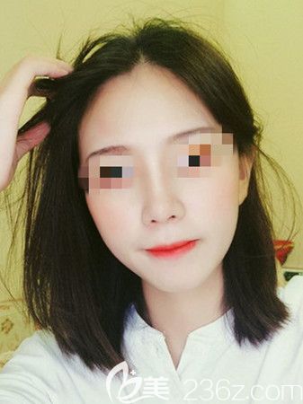 信陽東方藝鼻綜合術后15天 信陽東方藝鼻綜合術后15天