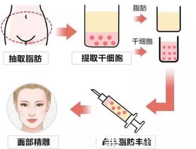 自體脂肪填充面部的手術(shù)示意圖
