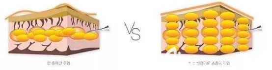 脂肪平鋪后的樣子