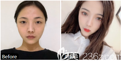 東莞維多利亞雙眼皮效果圖 東莞維多利亞雙眼皮效果圖