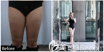 東莞維多利亞醫(yī)生大腿吸脂效果圖 東莞維多利亞醫(yī)生大腿吸脂效果圖