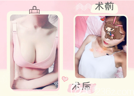 隆胸假體取出的同時做脂肪豐胸的圖