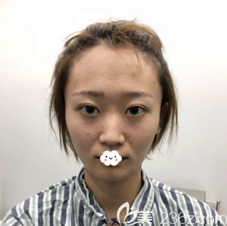 在廣州中家醫(yī)做隆鼻術(shù)前照片 在廣州中家醫(yī)做隆鼻術(shù)前照片