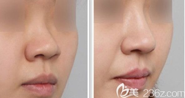 韓國Licol五分鐘生物肋骨鼻<span style=