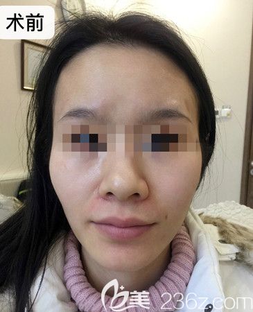 全臉脂肪填充術(shù)前 全臉脂肪填充術(shù)前