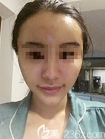 術(shù)后1個(gè)月 術(shù)后1個(gè)月