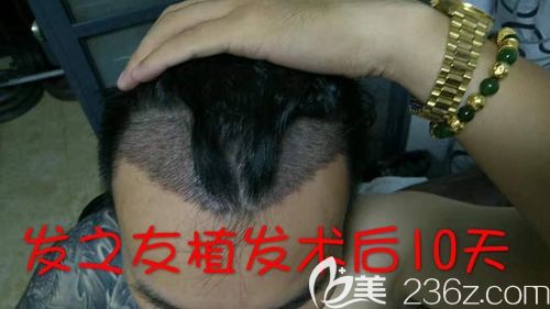 我前額雄性脫發(fā)有幸通過(guò)FD-FUE植發(fā)技術(shù)躲過(guò)了“中年危機(jī)”