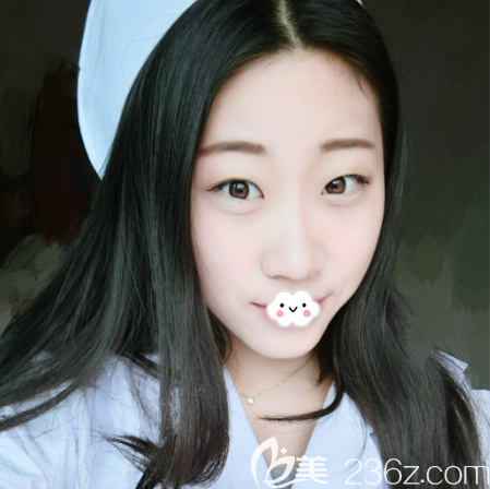 找廣州海峽閆倫醫(yī)生做雙眼皮術(shù)前照片 找廣州海峽閆倫醫(yī)生做雙眼皮術(shù)前照片